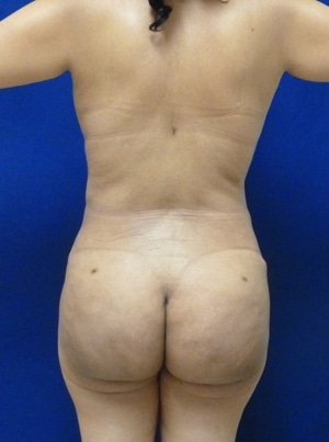 Brazilian Butt Lift after, case 1023, back view (Female, 51: BBL (1,100 cc per side))