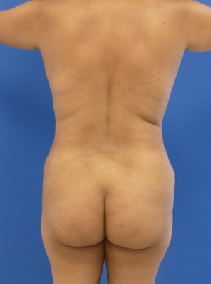 Brazilian Butt Lift before, case 1023, back view (Female, 51: BBL (1,100 cc per side))