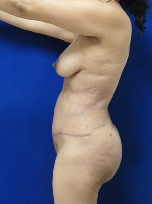 Brazilian Butt Lift after, case 1023, side view (Female, 51: BBL (1,100 cc per side))