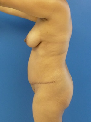 Brazilian Butt Lift before, case 1023, side view (Female, 51: BBL (1,100 cc per side))