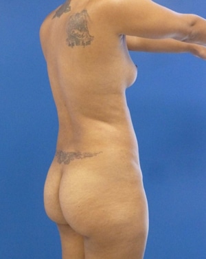 Brazilian Butt Lift before, case 1003, angle view (Female, 29: BBL (1,400 cc per side))