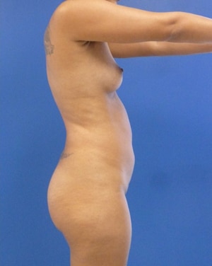 Brazilian Butt Lift before, case 1003, side view (Female, 29: BBL (1,400 cc per side))