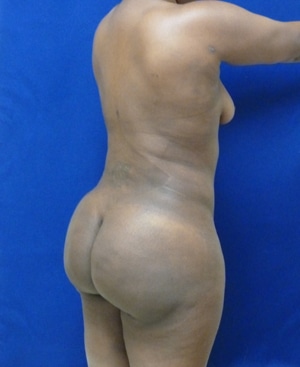 Brazilian Butt Lift after, case 1020, angle view (Female, 34: BBL (1,300 cc per side))