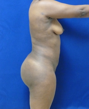 Brazilian Butt Lift after, case 1020, side view (Female, 34: BBL (1,300 cc per side))