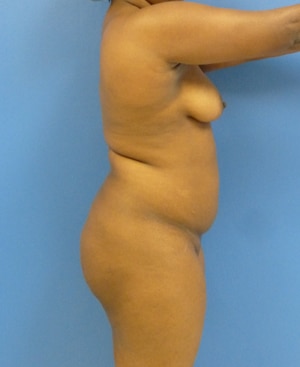 Brazilian Butt Lift before, case 1020, side view (Female, 34: BBL (1,300 cc per side))