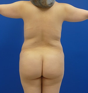 Brazilian Butt Lift before, case 1016, back view (Female, 30: BBL (950 cc per side))