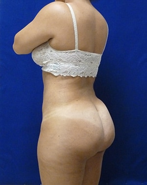 Brazilian Butt Lift after, case 1015, angle view (Female, 27: BBL (1,000 cc per side))