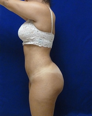 Brazilian Butt Lift after, case 1015, side view (Female, 27: BBL (1,000 cc per side))