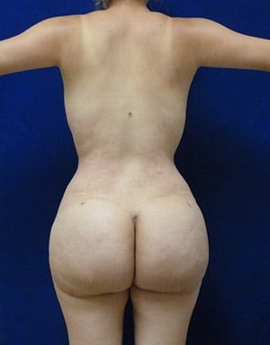 Brazilian Butt Lift after, case 1014, back view (Female, 23: BBL (1,300 cc per side))