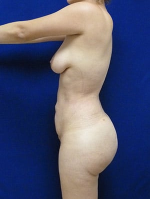 Brazilian Butt Lift after, case 1014, side view (Female, 23: BBL (1,300 cc per side))