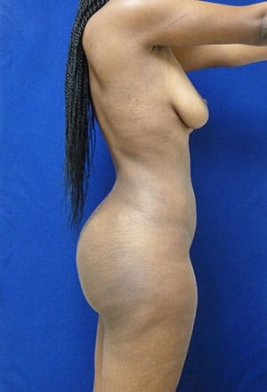 Brazilian Butt Lift after, case 1011, side view (Female, 25: BBL (1,300 cc per side))