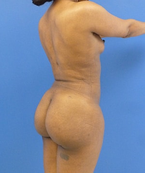 Brazilian Butt Lift after, case 1010, angle view (Female, 26: BBL (1,250 cc per side))
