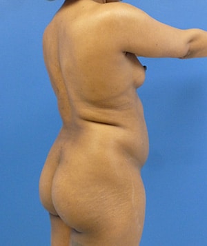 Brazilian Butt Lift before, case 1010, angle view (Female, 26: BBL (1,250 cc per side))