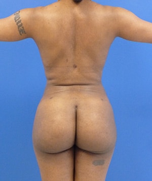 Brazilian Butt Lift after, case 1010, back view (Female, 26: BBL (1,250 cc per side))