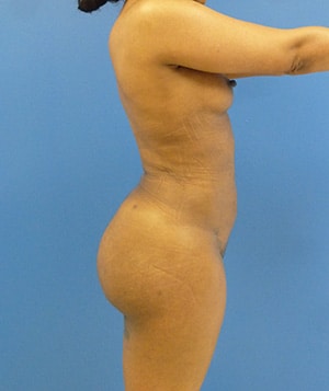 Brazilian Butt Lift after, case 1010, side view (Female, 26: BBL (1,250 cc per side))