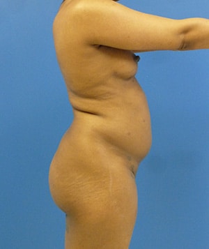 Brazilian Butt Lift before, case 1010, side view (Female, 26: BBL (1,250 cc per side))