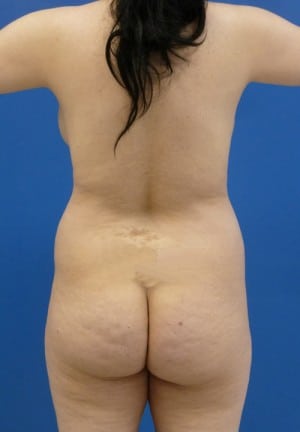 Brazilian Butt Lift before, case 1005, back view (Female, 27: BBL (1,450 cc per side))