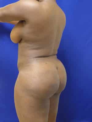 Brazilian Butt Lift after, case 1012, angle view (Female, 35: BBL (1,300 cc per side))