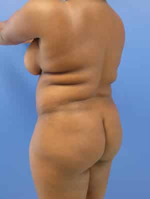 Brazilian Butt Lift before, case 1012, angle view (Female, 35: BBL (1,300 cc per side))