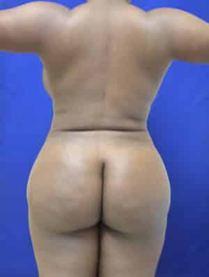 Brazilian Butt Lift after, case 1012, back view (Female, 35: BBL (1,300 cc per side))