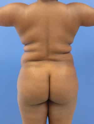 Brazilian Butt Lift before, case 1012, back view (Female, 35: BBL (1,300 cc per side))