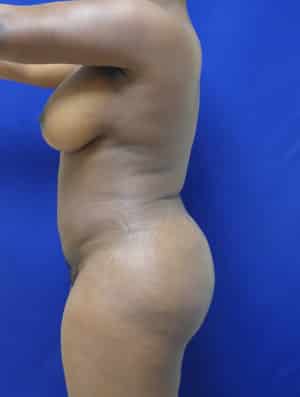 Brazilian Butt Lift after, case 1012, side view (Female, 35: BBL (1,300 cc per side))