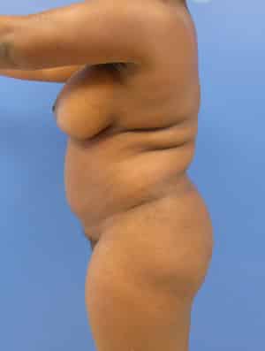 Brazilian Butt Lift before, case 1012, side view (Female, 35: BBL (1,300 cc per side))