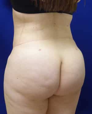 Brazilian Butt Lift after, case 1019, angle view (Female, 27: BBL (1,500 cc per side))