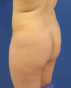 Brazilian Butt Lift before, case 1019, angle view (Female, 27: BBL (1,500 cc per side))