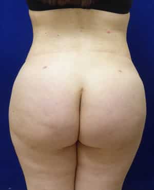 Brazilian Butt Lift after, case 1019, back view (Female, 27: BBL (1,500 cc per side))