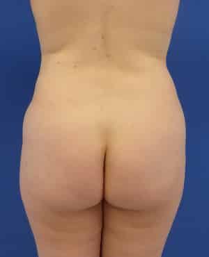 Brazilian Butt Lift before, case 1019, back view (Female, 27: BBL (1,500 cc per side))