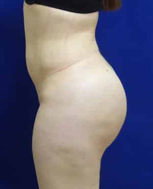 Brazilian Butt Lift after, case 1019, side view (Female, 27: BBL (1,500 cc per side))