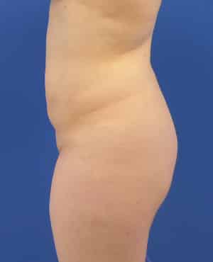 Brazilian Butt Lift before, case 1019, side view (Female, 27: BBL (1,500 cc per side))