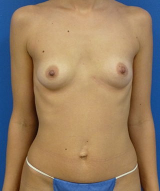 Breast Augmentation before, case 1250, front view