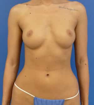 Breast Augmentation before, case 1249, front view