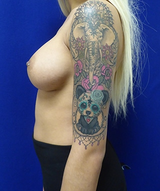 Breast Augmentation after, case 1248, side view