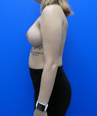 Breast Augmentation after, case 1247, side view