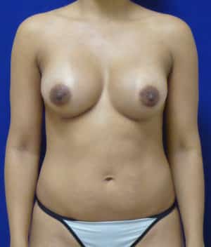 Breast Augmentation after, case 1242, front view
