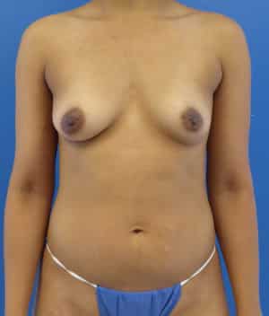 Breast Augmentation before, case 1242, front view