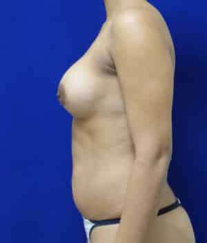 Breast Augmentation after, case 1242, side view