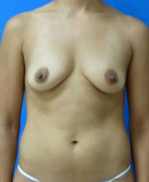Breast Augmentation before, case 1240, front view