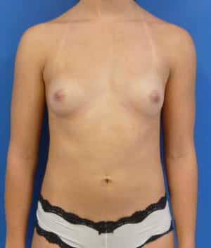 Breast Augmentation before, case 1256, front view