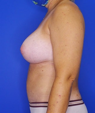 Breast Augmentation after, case 1262, side view