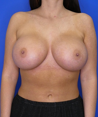 Breast Augmentation after, case 1263, front view