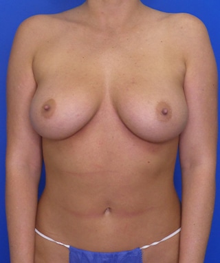 Breast Augmentation before, case 1263, front view