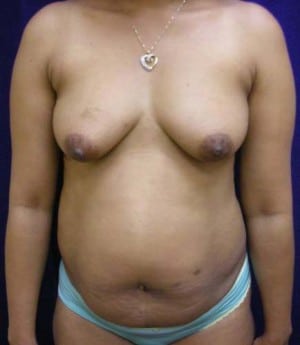 Breast Augmentation before, case 1267, front view