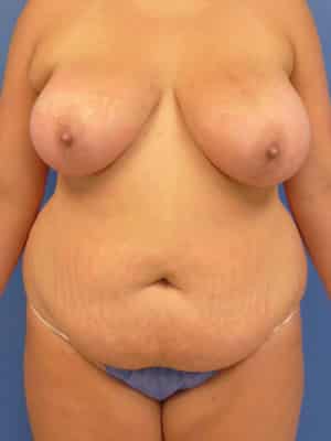 Breast Lift before, case 1273, front view