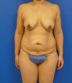 Levantamiento de Senos con Implantes antes, caso 1302, vista frontal