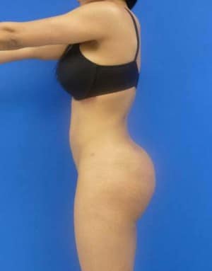 Butt Implants after, case 1206, side view