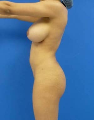 Butt Implants before, case 1206, side view
